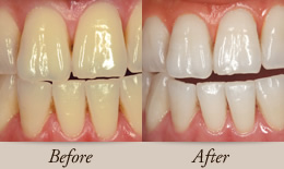 オフィスホワイトニング | JinMei Dental Clinic