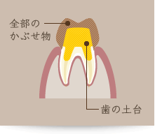 歯の土台+全部のかぶせ物