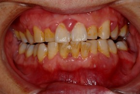 （治療前） 前歯の歯と歯の間の歯茎が特に腫れています