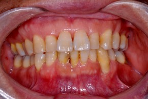 （治療後） 歯茎の腫れが改善し、歯茎が引き締まった状態です